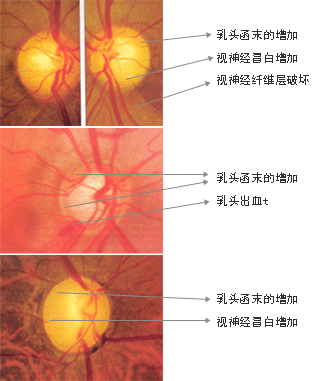 a. 视神经的变化